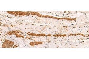 Immunohistochemistry of paraffin-embedded Human liver cancer tissue using ZFYVE27 Polyclonal Antibody at dilution of 1:50(x200) (ZFYVE27 抗体)