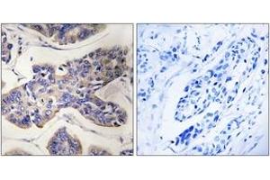 Immunohistochemistry analysis of paraffin-embedded human breast carcinoma tissue, using TAOK1 Antibody. (TAO Kinase 1 (TAOK1) (AA 431-480) 抗体)