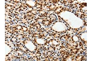 The image on the left is immunohistochemistry of paraffin-embedded Human thyroid cancer tissue using ABIN7192627(SPATA20 Antibody) at dilution 1/70, on the right is treated with synthetic peptide. (SPATA2 抗体)