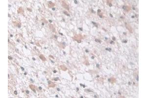 Detection of tPK1 in Human Glioma Tissue using Polyclonal Antibody to Tau-Protein Kinase 1 (tPK1) (TPK1 抗体  (AA 34-300))