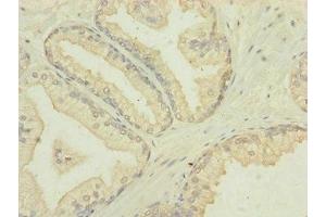 Immunohistochemistry of paraffin-embedded human prostate cancer using ABIN7172905 at dilution of 1:100