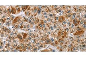 Immunohistochemistry of paraffin-embedded Human liver cancer tissue using CYP27A1 Polyclonal Antibody at dilution 1:50 (CYP27A1 抗体)