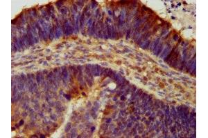 IHC image of ABIN7143000 diluted at 1:300 and staining in paraffin-embedded human ovarian cancer performed on a Leica BondTM system. (ACCN1 抗体  (AA 197-345))