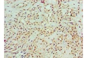 Immunohistochemistry of paraffin-embedded human breast cancer using ABIN7143157 at dilution of 1:100 (ASCC3 抗体  (AA 1-111))