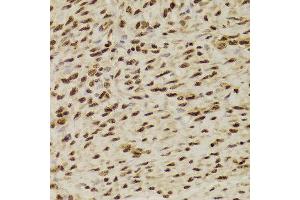 Immunohistochemistry of paraffin-embedded Human adenomyosis using ANP32A antibody at dilution of 1:100 (x400 lens). (PHAP1 抗体)