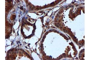 Immunohistochemical staining of paraffin-embedded Human breast tissue using anti-CYB5R3 mouse monoclonal antibody. (CYB5R3 抗体)