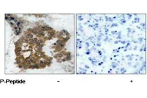 Immunohistochemical analysis of paraffin-embedded human lung carcinoma tissue using AKT2 (phospho S474) polyclonal antibody . (AKT2 抗体  (pSer474))