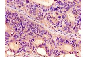 Immunohistochemistry of paraffin-embedded human colon cancer using ABIN7164713 at dilution of 1:100