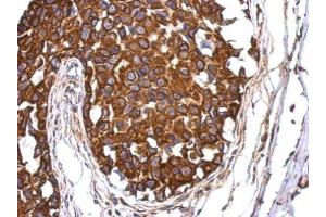 IHC-P Image Immunohistochemical analysis of paraffin-embedded human breast cancer, using Aladin, antibody at 1:500 dilution. (Adracalin 抗体  (Internal Region))