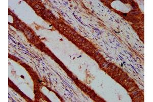 IHC image of ABIN7169218 diluted at 1:600 and staining in paraffin-embedded human colon cancer performed on a Leica BondTM system. (VRK2 抗体  (AA 317-472))