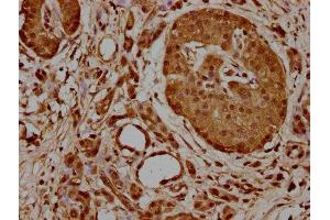 IHC image of ABIN7154863 diluted at 1:700 and staining in paraffin-embedded human pancreatic cancer performed on a Leica BondTM system. (HSP70 1A 抗体  (AA 291-641))
