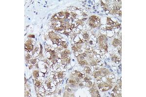Immunohistochemistry of paraffin-embedded human liver cancer using MT2A Rabbit pAb (ABIN3015841, ABIN3015842, ABIN3015843 and ABIN6219186) at dilution of 1:150 (40x lens). (MT2A 抗体  (AA 1-61))