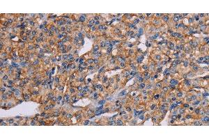 Immunohistochemistry of paraffin-embedded Human prostate cancer tissue using GHITM Polyclonal Antibody at dilution 1:30 (GHITM 抗体)