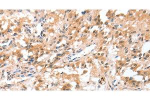 Immunohistochemistry of paraffin-embedded Human thyroid cancer using CIDEC Polyclonal Antibody at dilution of 1:50 (CIDEC 抗体)