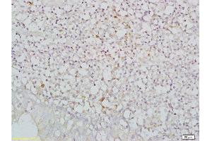 Formalin-fixed and paraffin embedded human nasopharyngeal carcinoma labeled with Anti-NKG2D/CD314/KLRK1 Polyclonal Antibody, Unconjugated  at 1:200, followed by conjugation to the secondary antibody and DAB staining (KLRK1 抗体  (AA 121-219))
