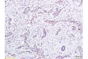 Formalin-fixed and paraffin embedded human tumor tissue labeled with Anti-HPV16-E6 Polyclonal Antibody, Unconjugated at 1:200, followed by conjugation to the secondary antibody and DAB staining (人 Papilloma Virus 16 E6 (HPV-16 E6) (AA 85-158) 抗体)