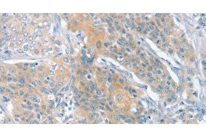 Immunohistochemistry of paraffin-embedded Human cervical cancer using SLIT2 Polyclonal Antibody at dilution of 1:30 (SLIT2 抗体)