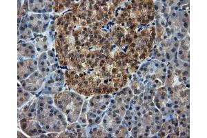 Immunohistochemical staining of paraffin-embedded Adenocarcinoma of ovary tissue using anti-RC201933 mouse monoclonal antibody. (PIM2 抗体)