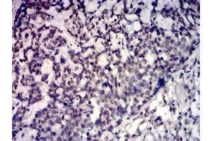 Immunohistochemical analysis of paraffin-embedded esophageal cancer tissues using TBP mouse mAb with DAB staining. (TBP 抗体  (AA 1-144))