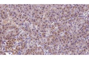 ABIN6273254 at 1/100 staining Human pancreas cancer tissue by IHC-P. (HBS1L 抗体  (N-Term))