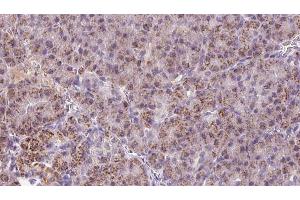 ABIN6273254 at 1/100 staining Human pancreas cancer tissue by IHC-P. (HBS1L 抗体  (N-Term))