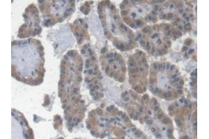 Detection of EPO in Human Thyroid cancer Tissue using Monoclonal Antibody to Erythropoietin (EPO) (EPO 抗体  (AA 28-193))