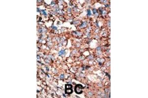 Formalin-fixed and paraffin-embedded human cancer tissue reacted with the primary antibody, which was peroxidase-conjugated to the secondary antibody, followed by AEC staining. (DNAJB1 抗体)