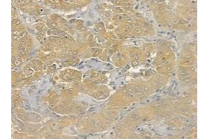 ABIN6265287 and ABIN6273167 at 1/100 staining human lung adenocarcinoma by IHC-P.