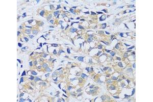 Immunohistochemistry of paraffin-embedded Human breast cancer using CABP7 Polyclonal Antibody at dilution of 1:100 (40x lens). (CABP7 抗体)