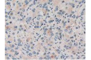 IHC-P analysis of Human Prostate Gland Cancer Tissue, with DAB staining. (TOR1A 抗体  (AA 33-321))