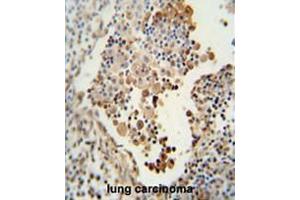CADM1 antibody (N-term) immunohistochemistry analysis in formalin fixed and paraffin embedded human lung carcinoma followed by peroxidase conjugation of the secondary antibody and DAB staining. (CADM1 抗体  (N-Term))
