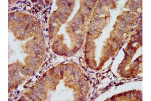 IHC image of ABIN7153633 diluted at 1:500 and staining in paraffin-embedded human endometrial cancer performed on a Leica BondTM system.