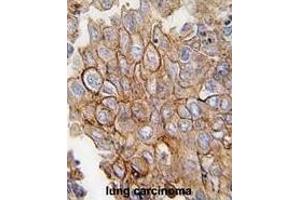 Formalin-fixed and paraffin-embedded human lung carcinoma tissue reacted with ANXA2 antibody (C-term) (ABIN391620 and ABIN2841539) , which was peroxidase-conjugated to the secondary antibody, followed by DAB staining. (Annexin A2 抗体  (C-Term))