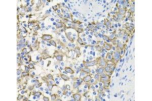 Immunohistochemistry of paraffin-embedded Human esophageal cancer using ACVR2A Polyclonal Antibody at dilution of 1:100 (40x lens). (ACVR2A 抗体)