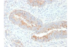 Formalin-fixed, paraffin-embedded human Colon Carcinoma stained with Erythropoietin (EPO) Mouse Monoclonal Antibody (EPO/1367). (EPO 抗体  (AA 28-162))