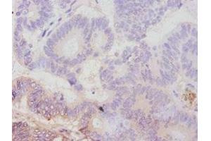 Immunohistochemistry of paraffin-embedded human colon cancer using ABIN7179111 at dilution of 1:100 (AVPR1A 抗体  (AA 7-52))
