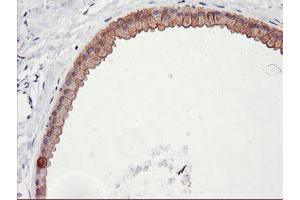 Immunohistochemical staining of paraffin-embedded Human breast tissue using anti-DGKA mouse monoclonal antibody. (DGKA 抗体)