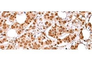 Immunohistochemistry of paraffin-embedded Human breast cancer tissue using RCOR3 Polyclonal Antibody at dilution of 1:60(x200) (RCOR3 抗体)