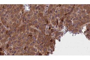 ABIN6277220 at 1/100 staining Human liver cancer tissue by IHC-P. (AP2M1 抗体  (Internal Region))