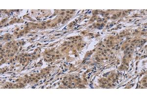 Immunohistochemistry of paraffin-embedded Human gastric cancer tissue using IPO8 Polyclonal Antibody at dilution 1:50 (Importin 8 抗体)