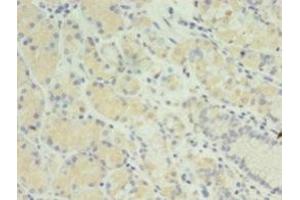 Immunohistochemistry of paraffin-embedded human gastric cancer using ABIN7165811 at dilution of 1:100 (MIS12 抗体  (AA 1-305))