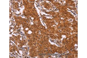 Immunohistochemistry of Human gastric cancer using APMAP Polyclonal Antibody at dilution of 1:30 (APMAP 抗体)