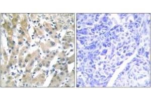 Immunohistochemistry analysis of paraffin-embedded human liver carcinoma tissue, using THRB Antibody. (THRB 抗体  (AA 391-440))