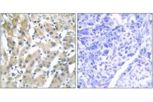 Immunohistochemistry analysis of paraffin-embedded human liver carcinoma tissue, using THRB Antibody. (THRB 抗体  (AA 391-440))