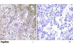 Immunohistochemistry analysis of paraffin-embedded human liver carcinoma tissue using ACOT12 polyclonal antibody . (ACOT12 抗体)