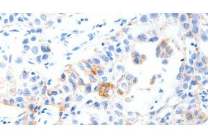 Immunohistochemistry of paraffin-embedded Human lung cancer tissue using MUC3A Polyclonal Antibody at dilution 1:60 (MUC3A 抗体)