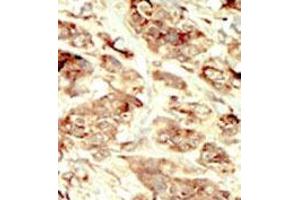 Formalin-fixed and paraffin-embedded human cancer tissue 8breast carcinoma) reacted with the primary antibody, which was peroxidase-conjugated to the secondary antibody, followed by DAB staining. (STK35 抗体  (Middle Region))