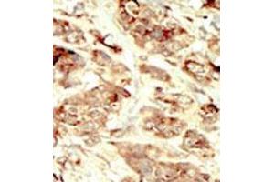 Formalin-fixed and paraffin-embedded human cancer tissue 8breast carcinoma) reacted with the primary antibody, which was peroxidase-conjugated to the secondary antibody, followed by DAB staining. (STK35 抗体  (Middle Region))