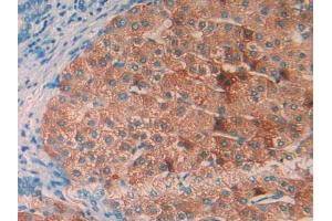 IHC-P analysis of Human Liver Cancer Tissue, with DAB staining. (IL1RAP 抗体  (AA 420-558))