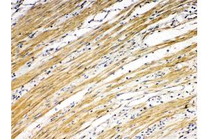 DR5 was detected in paraffin-embedded sections of human intetsinal cancer tissues using rabbit anti- DR5 Antigen Affinity purified polyclonal antibody (Catalog # ) at 1 µg/mL. (TNFRSF10B 抗体  (AA 233-440))